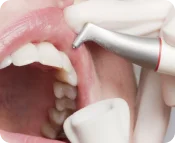 Комплексная чистка зубов Airflow