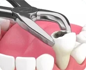 Удаление 3х зубов