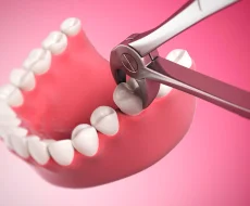 Сколько зубов отсутствует